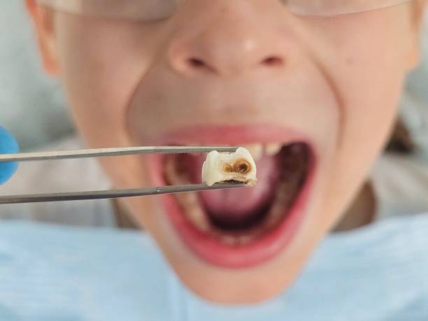 Best Emergency Dental Extractions in Milton, NY